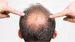 UncBaldSpott